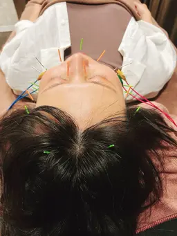 💆‍♀️美容鍼🪡＋ローラ＋肩甲骨剥がしミニモ学割✨