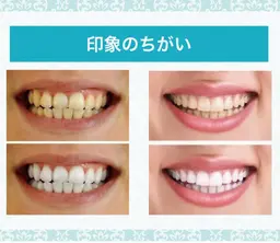 セルフホワイトニング