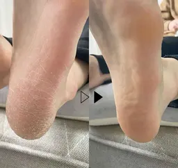 foot角質除去 無料モデル限定２名募集 10:00-11:00-
