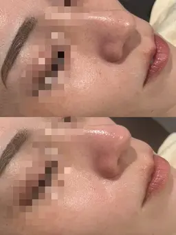 【毛穴洗浄◆ハイドロフェイシャル✕艶肌フェイスワックス】鎮静パック付🫧