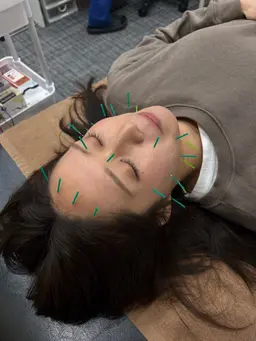 🌟新規掲載記念クーポン🌟 【美容鍼】通常6,000円 → 3,000円 初めての美容鍼でも安心の施術です🌿