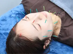 人気No.2💆‍♀️【小顔効果/フェイスライン/猫背/反り腰/頭痛/食いしばり】リフトUP美容鍼＋整体 60分