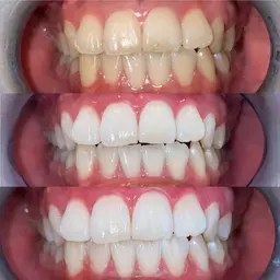 【セルフホワイトニング30分照射初回体験】歯の黄ばみを1～2ヶ月で理想の白い歯へ