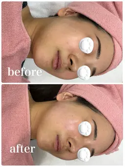 【ミニモ限定✨小顔ケア】EMSフェイスラインスッキリ¥2,500