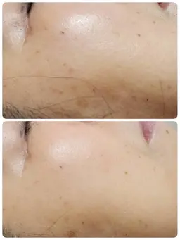 💎【スペシャルケア】美白ハーブピーリング