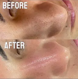 【メンズ限定】イケメンは肌育から！剥けないハーブピーリング🌿お持ち帰りパック付き！