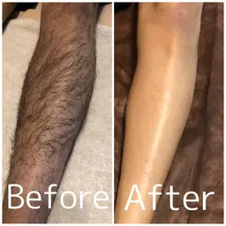 ミニモ学割⭐︎ ヒゲ脱毛通常¥6,600→¥3,500