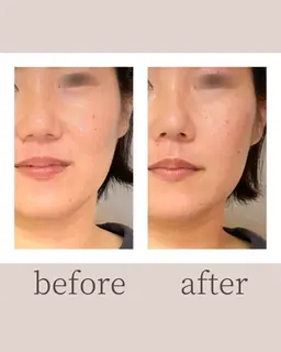 【モニター】目の下のたるみ・クマ集中＊すっきり目元集中ケア