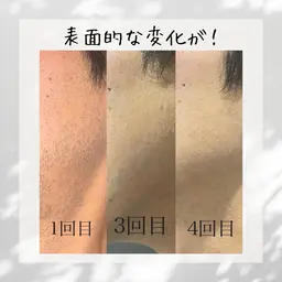 【男性】ヒゲ脱毛で清潔感🥸✨