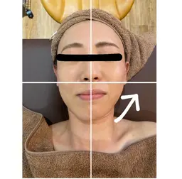 茨城県では珍しい顔用痩身！リフトアップ完全特化！小顔サーマルフラクショナルRF(60分)カウンセリング込み