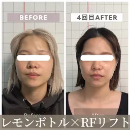 【エステ版ボトックス】RFリフト×小顔矯正 × リンパドレナージュ ×ヒト幹エステ¥7,980-【彫刻級小顔術】