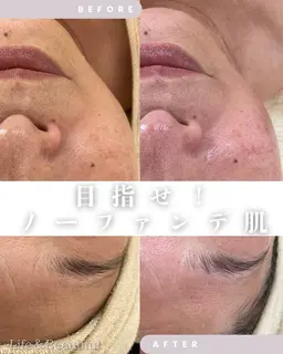 【肌再構築ピーリング】（くすみ・ニキビ後•ゴワつき即アプローチ🌟肌の土台を整える）※口コミ限定60%off