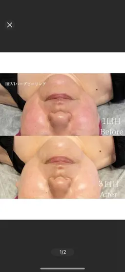 [毛穴、美白、ツヤ]韓国産🇰🇷剥離なしハーブピーリング🌿