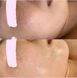 美肌フェイシャル💆‍♀️１名様限定✨８月１０日（土）午前中♡