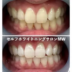 【ご新規様限定★】スタンダードコース🦷✨​〜​黄ばみや汚れをごっそり落とす​〜​(15分×2照射)