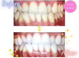 【12月限定サービスクーポン】医療提携セルフホワイトニング(9 分×2 回)1回¥3980→