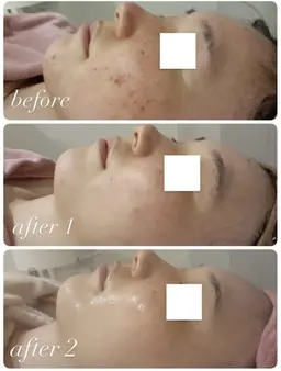 【光フェイシャルの再来の方🌼】フォトRF＋毛穴洗浄付きシンプルコース🌿フォトRFやその他メニューを継続されたい方へ✨