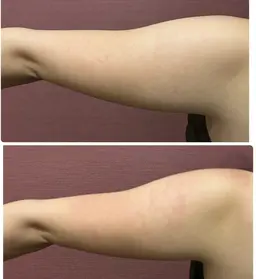 【痩身】二の腕すっきり！キャビテーション→ラジオ→吸引EMS  施術時間30分