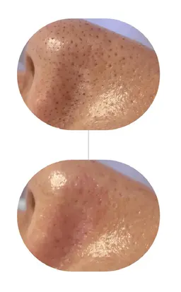 【黒ずみ毛穴撃退フェイシャル】&美デコルテマッサージ