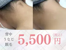 【脱毛】次世代脱毛でツルツル美肌<最新DPL式脱毛>背中/うなじ¥5,500