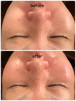 即効効果クリスマス限定本日中のみ【WiQo水光ピール×保湿パック付】最新美容＊即効ツヤ/ハリ。どこよりも最安値になります