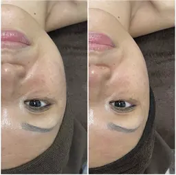 期間限定🌟口コミご協力いただければ¥1,000🌟高濃度コラーゲン泡×小顔コース約90（カウンセリング込み）