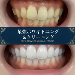 【最強セルフホワイトニング】クリーニング&効果2倍ジェル LED照射15分×2回　¥6600