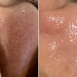 【毛穴洗浄】KIWAMIポセイドン×ヒト幹細胞美容液✨洗うたびに透き通る素肌へ