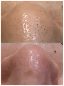 【鼻の毛穴洗浄】毛穴の詰まり/いちご鼻/毛穴の開き/ごわつき