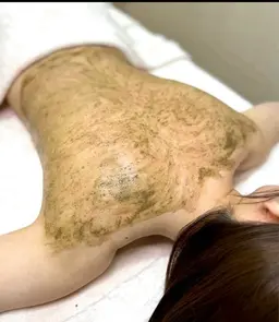 ✨背中ニキビ・痕・毛嚢炎・毛孔苔癬気になる方必見✨　【天然100%ハーブトリートメント🌿】