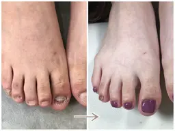 【フット深爪の方限定】再発させない深爪矯正お試し1回 ワンカラー仕上げ