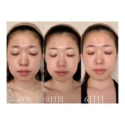 本気の肌質改善お手伝いします👌🏻毛穴ひらき ザラつき ニキビ跡 美白 たるみ 浮腫…おまかせ下さい🙆♀️