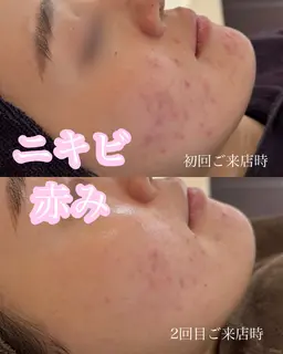 🌟3ヶ月フェイシャルモニター募集🌟赤み・ゆらぎ・ニキビ肌🫧ハーブピーリング/クリスティーナ/フェイシャルエステ