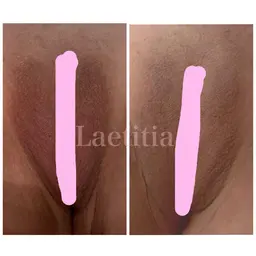 【特別キャンペーン価格✨】『12/31まで期間限定』ローマピンク🌸『Iライン』