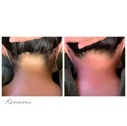 【WAX脱毛】お祭りや前撮り前に🩵うなじ美人🩵