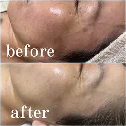 美肌リンパトリートメント＋韓国最新ララピール