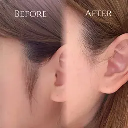 WAX脱毛（もみあげ、口周り、鼻、おでこ）の内いずれか1箇所