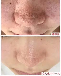 大人気毛穴エクストラクション！どんな毛穴もお任せください😊！黒ずみ毛穴、たるみ毛穴、メイクノリが悪いなど。