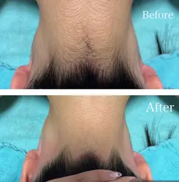 一般料金 ミニモ初回限定特別価格です🌟一般通常11000円（お友達紹介で1万円で通えます)VIO.顔含む