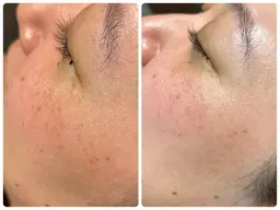 【角質・産毛除去で滑らかな肌へ】フェイシャルシェービング