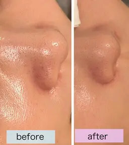 ✨毛穴キュ！光フェイシャルで美肌✨¥8,900→¥3500