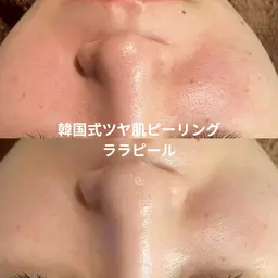 🧡モニター限定価格🧡ララピール｜優しいピーリングで韓国肌へ