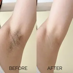 【学割U24】初めての脱毛応援★脇・うなじ・襟足脱毛　¥2000