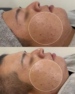 【黒ずみ角栓ごっそり】