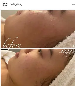 【当店が初めての方限定】毛穴クレンジング🪠🤍まずは毛穴ケアを体感したい方✨✨