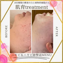 陶肌トリートメント小顔　毛穴洗浄コース🫧