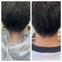 えりあし、うなじ脱毛