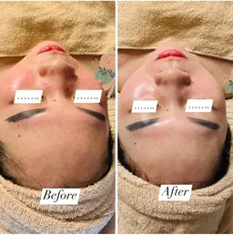 シミ美白ピーリング