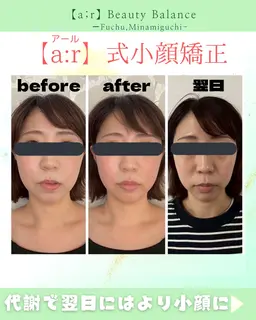 アール式小顔矯正(モニター募集)