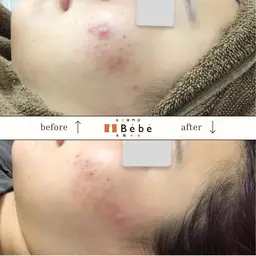 おかえりクーポン【再来】前回のご予約から3週間以内のご予約の場合、割引あり!お顔全体を吸引